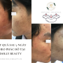 ANH H SAU 7 NGÀY ĐIỀU TRỊ TẠI DOLLY BEAUTY