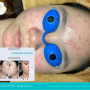 CHỊ N 17T SAU 7 NGÀY CHĂM SÓC DA TẠI DOLLY BEAUTY