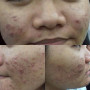 CHỊ T 22t CÙNG VỚI LÀN DA BỊ NHIỄM CORTICOID VÀ KẾT QUẢ
