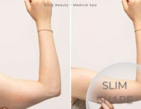 SLIM SHAPE - Giảm béo bắp tay